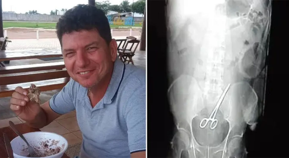 Hirurzi zaboravili makaze u čovjeku nakon operacije