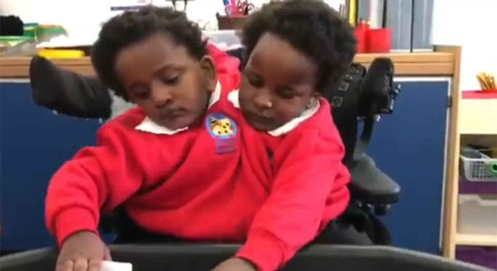 Очекивали да ће живјети неколико дана, а сијамске близнакиње прославиле и 7. рођендан