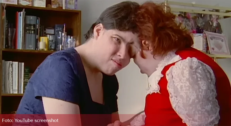 Преминули најстарији сијамски близанци на свијету