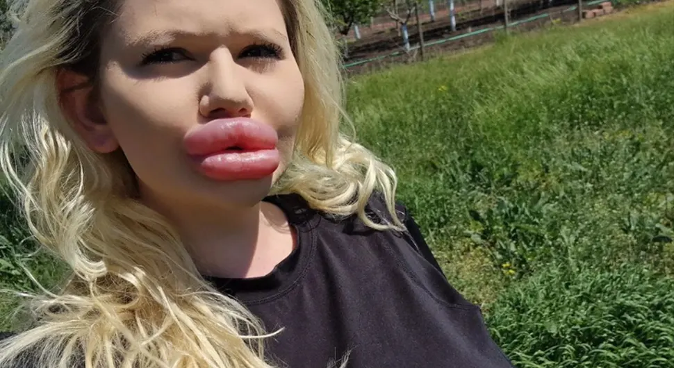 Има највеће усне на свијету и не планира да стане са корекцијама