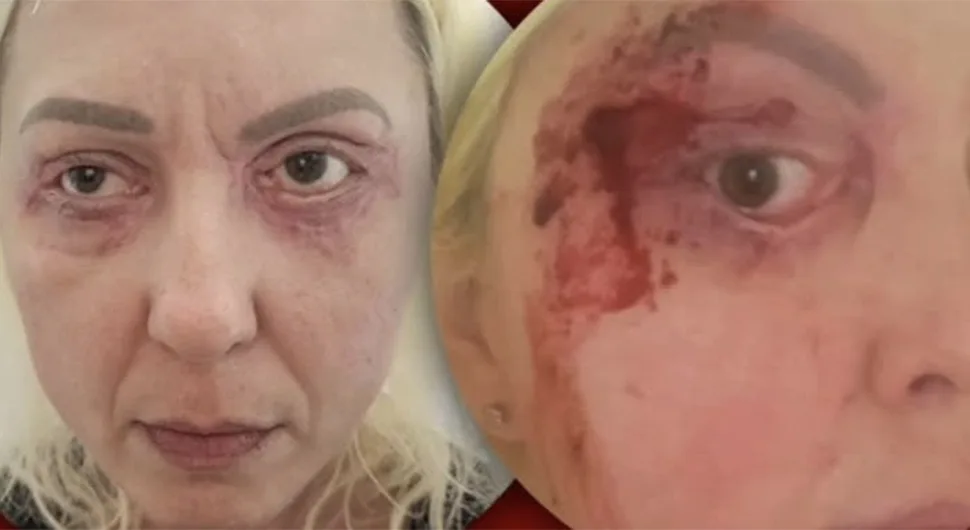 Јадранка из Бијељине болује од ријетке болести и треба нашу помоћ
