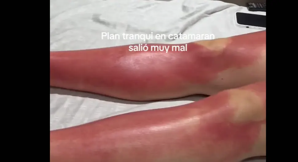Савршен љетни дан се претворио у хорор: Дјевојка задобила озбиљне опекотине сунчајући се на броду