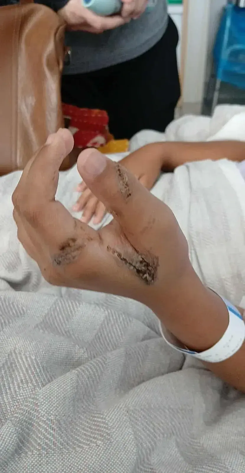 Опекотине од пуњача