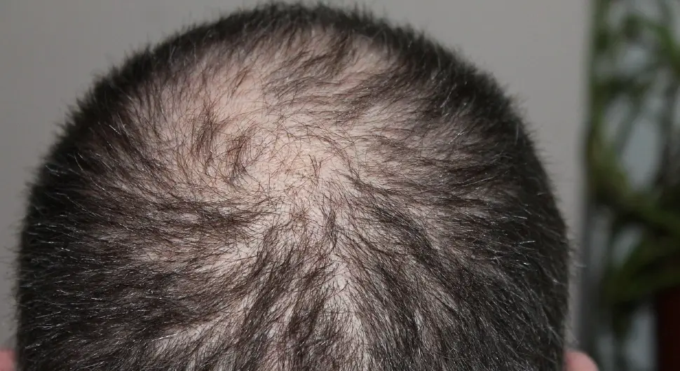 Тајван открио лијек за ћелавост: Длаке ничу за 20 дана!