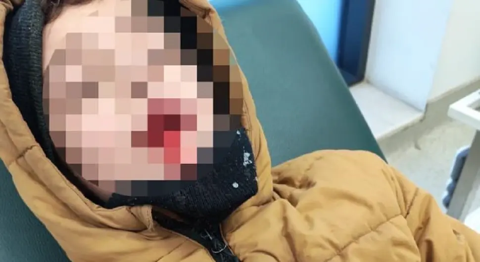 Ужас! Пас луталица откинуо дјетету горњу усну