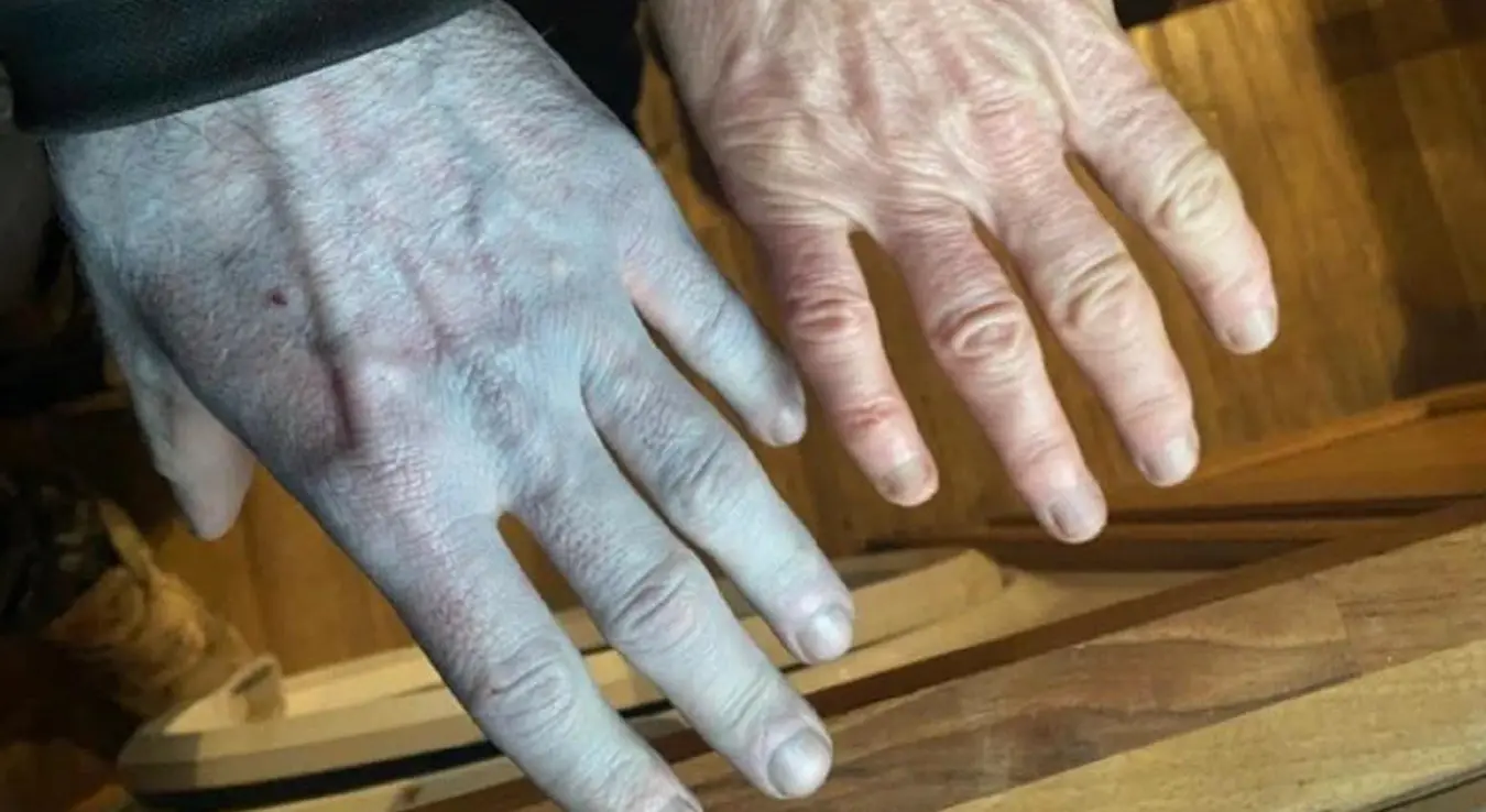 Због чаршава завршио у болници: Пробудио се потпуно плав