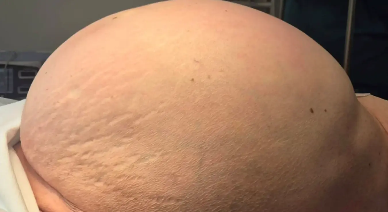 Тумор од 36 килограма