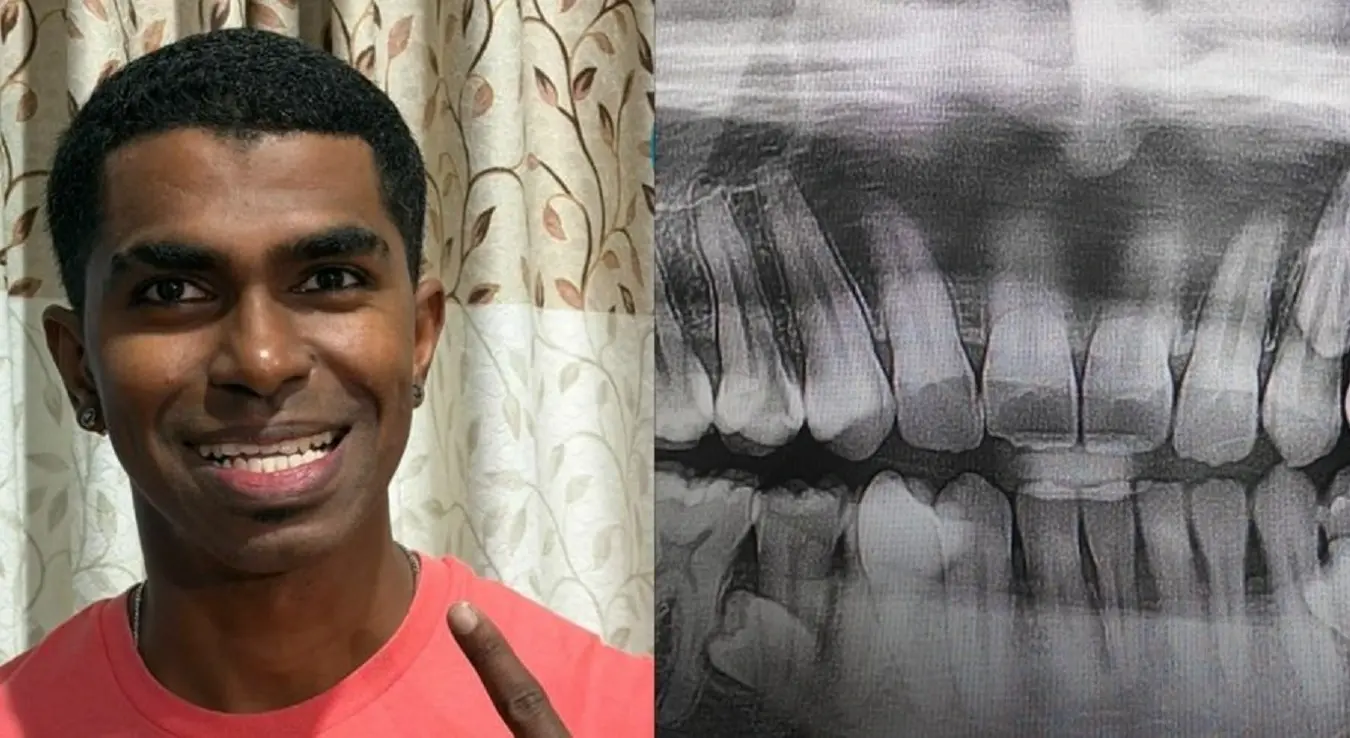 Имамо нови Гинисов рекорд: Овај човјек има 42 зуба